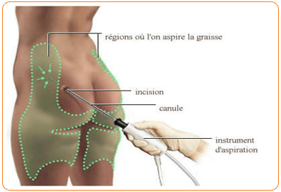 cliniques de liposuccion