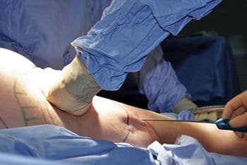 liposuccion des cuisses