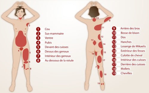 faire une liposuccion