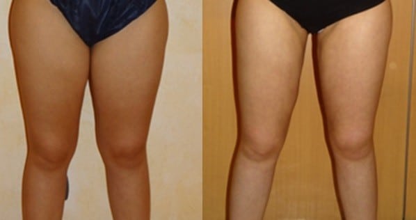 liposuccion des cuisses