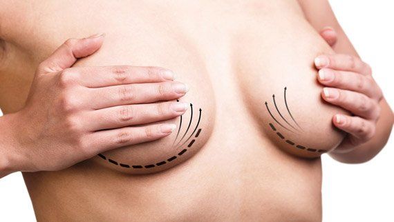 augmentation mammaire