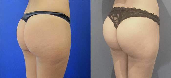 lipofilling fessier
