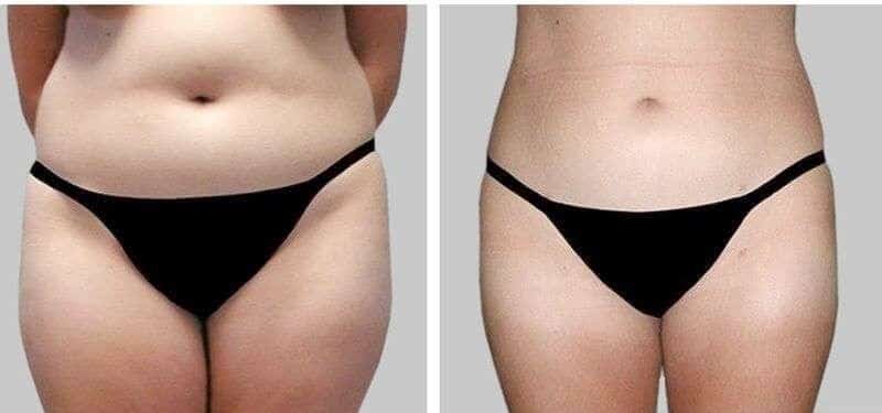 liposuccion du ventre