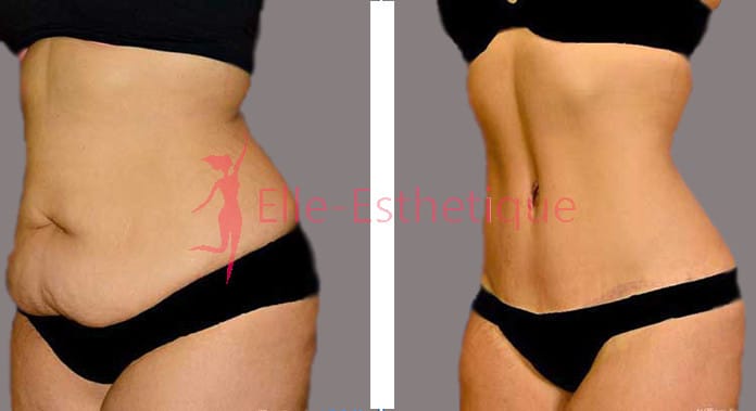 Abdominoplastie-Tunisie