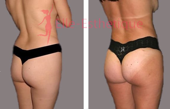 Implants-fessiers