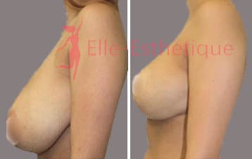 Lifting-des-seins