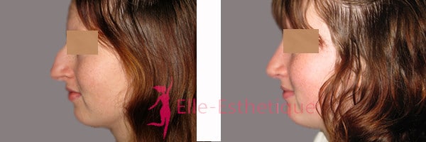 Rhinoplastie-resultat