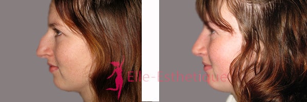 Rhinoplastie-resultat