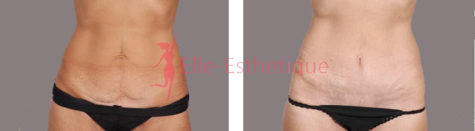 abdominoplastie
