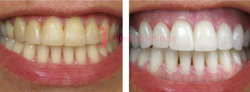 blanchiment des dents