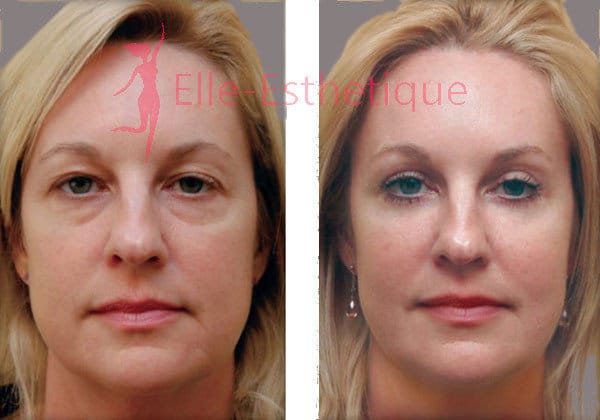 blepharoplastie-tunisie