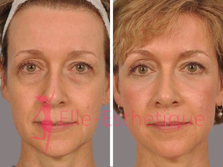 blepharoplastie