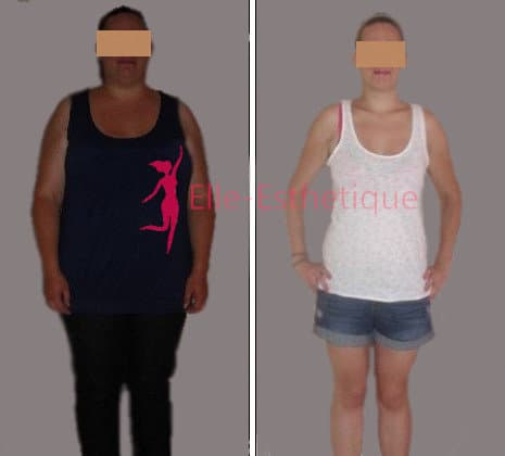 chirurgie de l’obésité