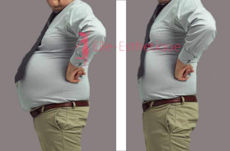 chirurgie de l’obésité avant apres