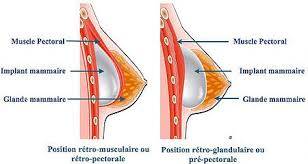 pose d'implant chirurgie mammaire tunisie