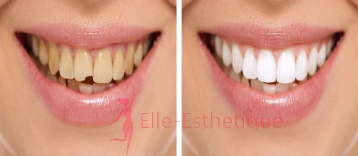 facette-dentaire-resultat