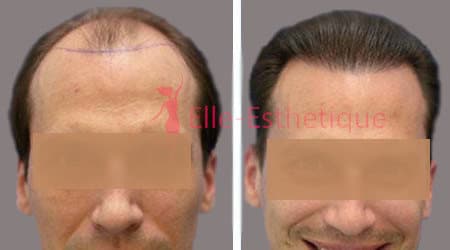 greffe des cheveux resultat