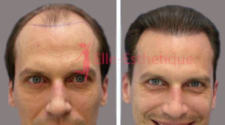 greffe des cheveux resultat