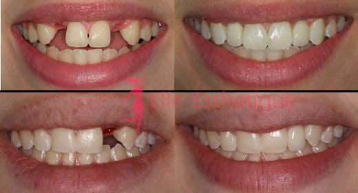 implant dentaire resultat