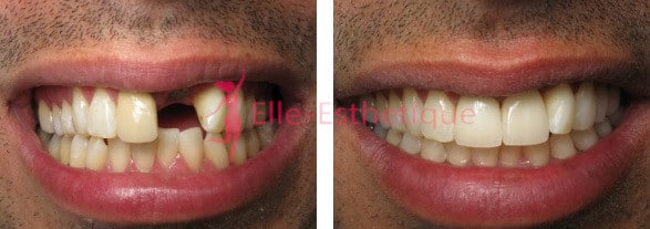 implant dentaire