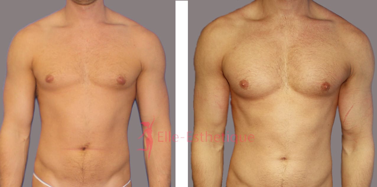 implants pectoraux avant apres