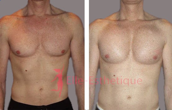 implants pectoraux resultat