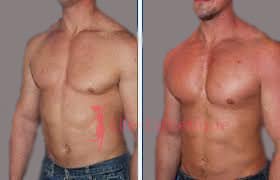 implants pectoraux