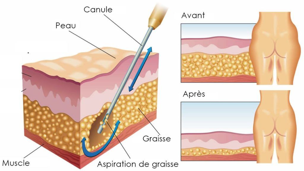 incision liposuccion