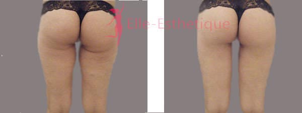 lifting-des-cuisses-avant-apres