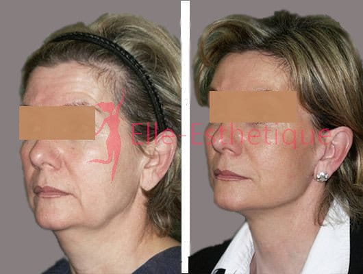 lifting du visage resultat