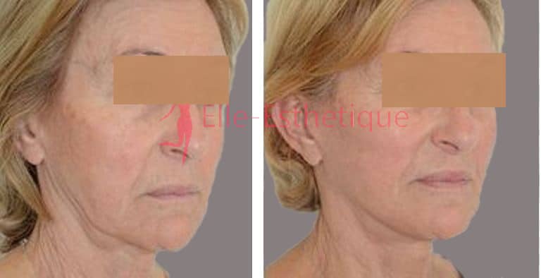 lifting du visage resultat