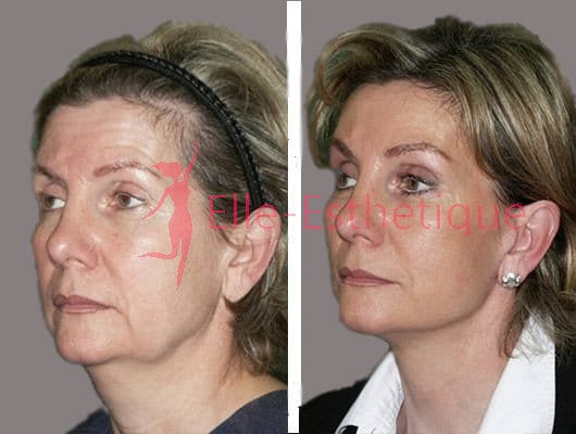 lifting du visage