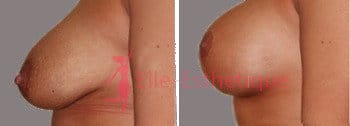 lifting-mammaire-2