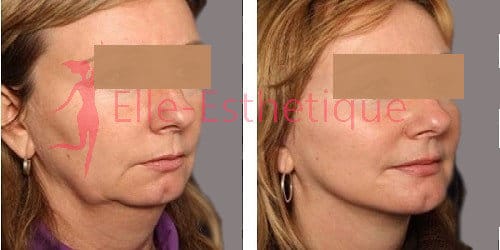 lifting du visage resultat