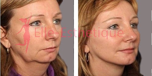 lifting-visage-avant-apres