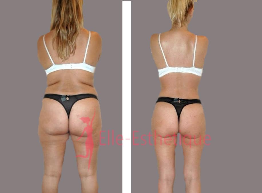 liposuccion des hanches