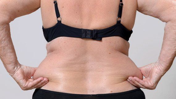 liposuccion du ventre