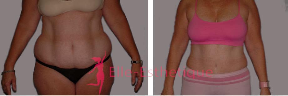 liposuccion resultat
