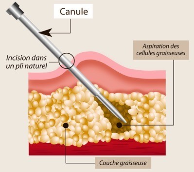 liposuccion tunisie