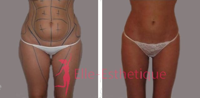 liposuccion