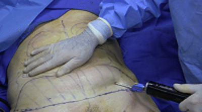 liposuccion ventre homme tunisie