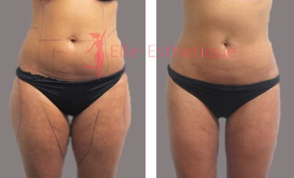 resultat-lifting-cuisses-tunisie