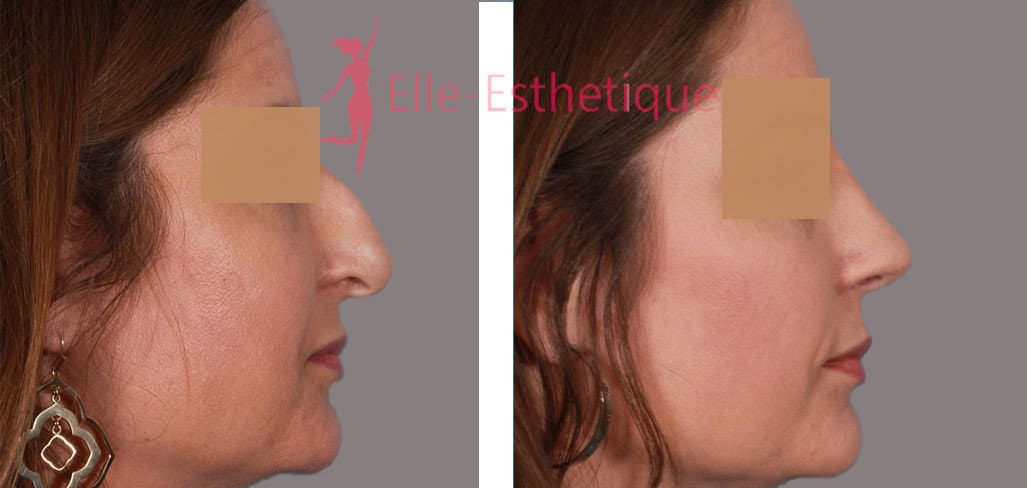 rhinoplastie-avant-apres