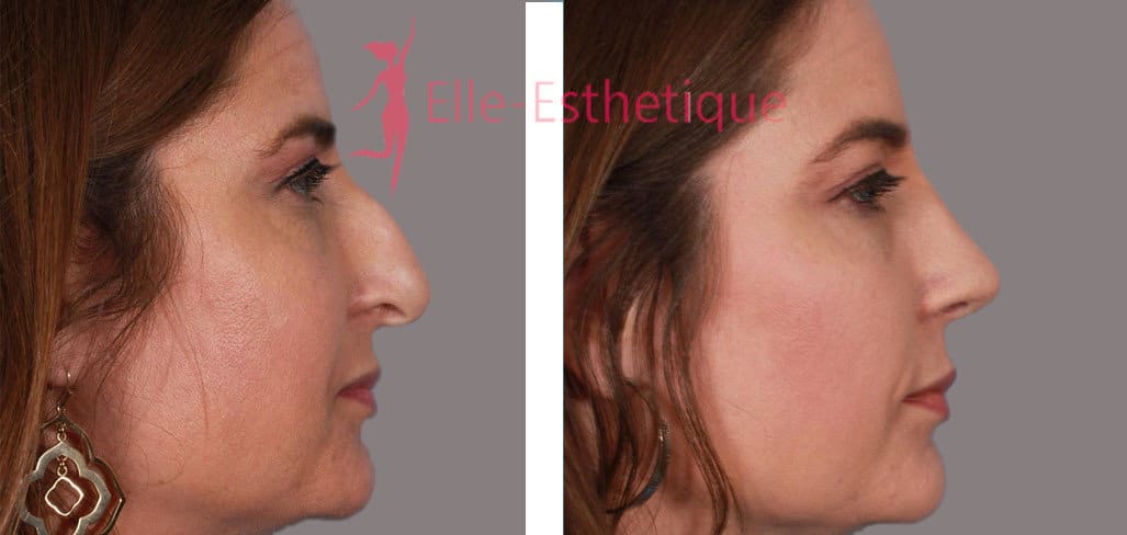 rhinoplastie-avant-apres