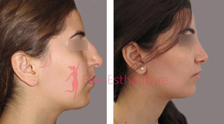 rhinoplastie