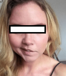 paralysie facial