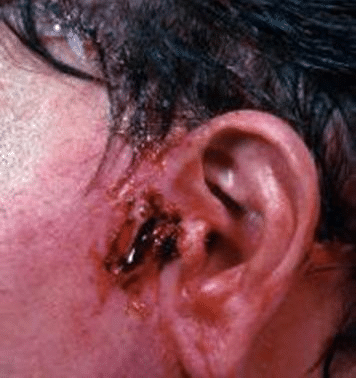 nécrose auriculaire