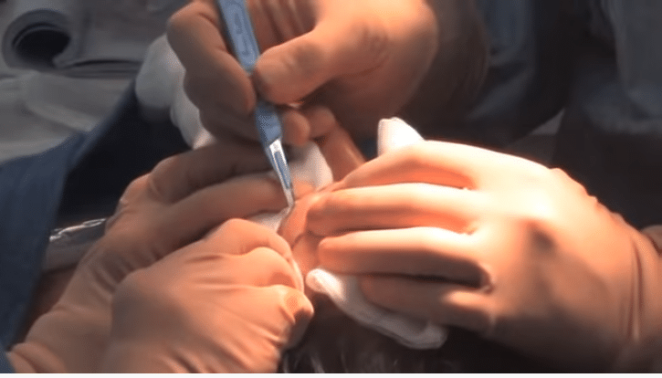 déroulement lifting de visage