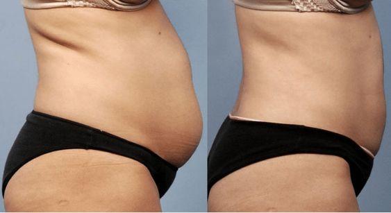 la liposuccion efficace pour éliminer définitivement les graisses