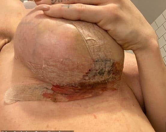 augmentation mammaire ratee en Turquie